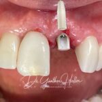 Dente e implante de Zirconia Neodent Straumann