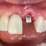 Dente e implante de Zirconia Neodent Straumann