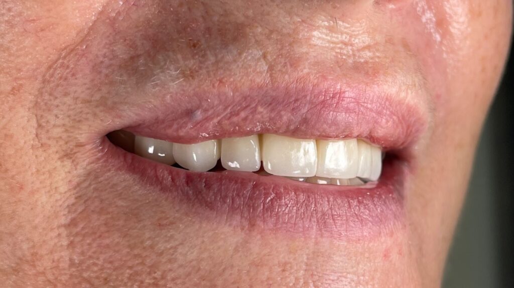 Zircônia implante dente faceta