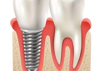 Implante dentária